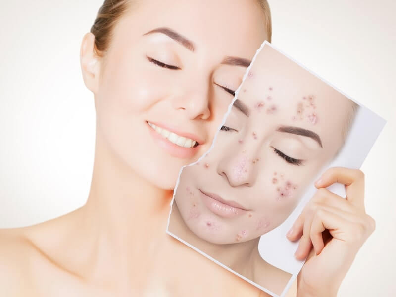 ニキビができたらクレアラシルで洗顔 全4種類を使い分けて正しいケアを バスタイムクラブ